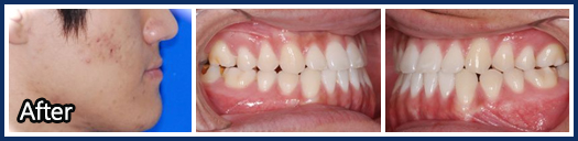 3급 부정교합(Class III malocclusion)1