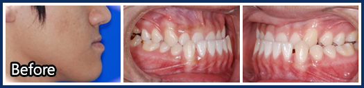 3급 부정교합(Class III malocclusion)1