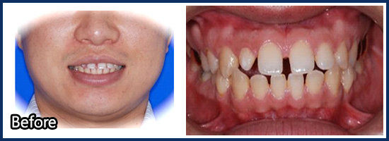 공간(Diastema)