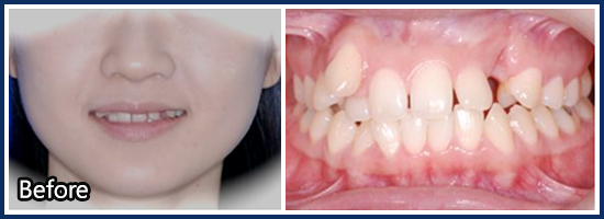 매복치아(Tooth impaction)