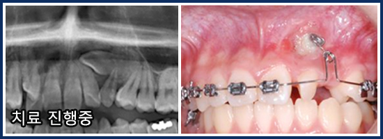 매복치아(Tooth impaction)