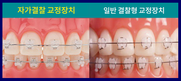 Self-ligating Bracket (자가 결찰 브라켓)