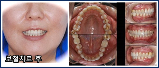 잇몸질환 등으로 틀어진 치아들의 교정