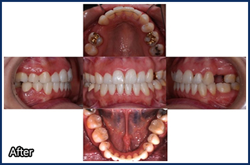 발치 공간을 위한 교정치료