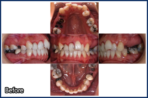 발치 공간을 위한 교정치료